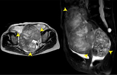 Case report: Olaparib as an experimental therapy in a BRCA2-mutated patient with metastatic ovarian adenocarcinoma that originated from liver cancer